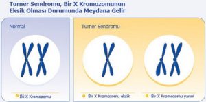 bebeklerde-boy-kısalığı