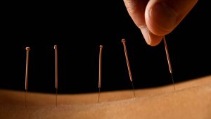 Akupunktur Nedir ve Türleri Nelerdir 3