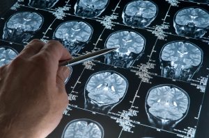Alzheimer  Hastalığının Tedavisi Nasıl Yapılır 2
