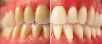 Diş Tartarı Nedir ve Nasıl Tedavi Edilir 2