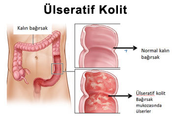 kolit-hastalığı-nedir?