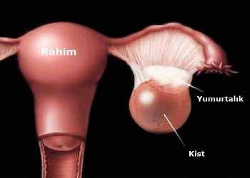 kadinlarda-kistler-ve-tedavi-yontemleri-nelerdir-2