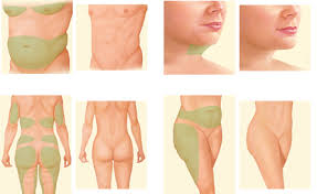 liposculpture-nasil-yapilir-4