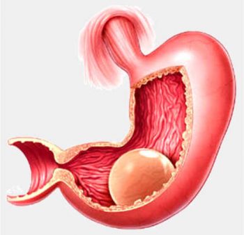 zayiflatici-mide-balonu-nedir-ve-kimlere-uygulanir-1