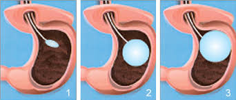 zayiflatici-mide-balonu-nedir-ve-kimlere-uygulanir-4