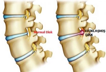 boyun-fitigi-tedavisi-nasil-yapilir-2