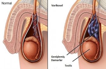 varikosel-tedavisi-nasil-yapilir-3