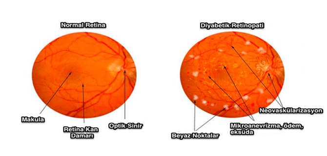 diyabetik-retinopati-nedir-ve-tedavisi-nasil-yapilir-3