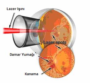 diyabetik-retinopati-nedir-ve-tedavisi-nasil-yapilir-5