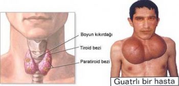 guatr-nedir-belirtileri-nelerdir-ve-tedavisi-nasil-yapilir-1