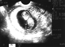 kadinlarda-hamileligin-onbirinci-haftasinda-yasanacak-degisimler-nelerdir-4