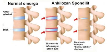 romatizmal-hastalik-nedir-ve-hastalikla-nasil-yasanir-2