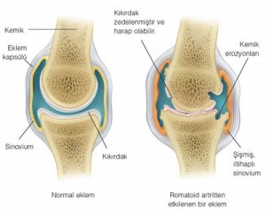 romatizmal-hastalik-nedir-ve-hastalikla-nasil-yasanir-4