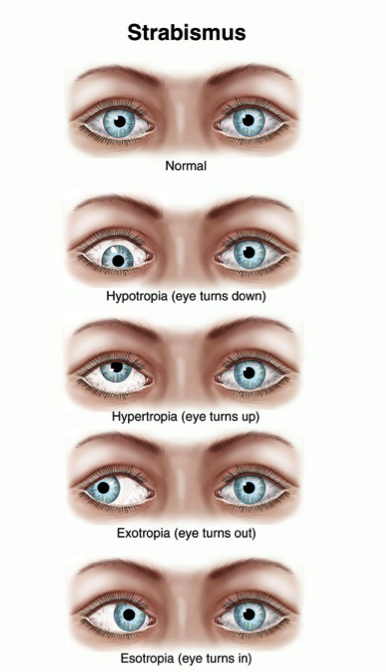 sasilik-nedir-nasil-olusur-ve-tedavisi-nasil-yapilir-2