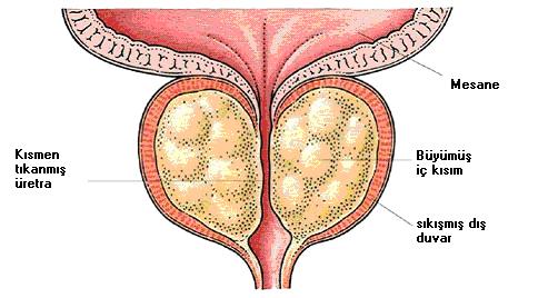 prostat-nedir-ve-tedavi-yontemleri-nelerdir-1