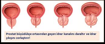 prostat-nedir-ve-tedavi-yontemleri-nelerdir-2