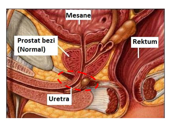 prostat-nedir-ve-tedavi-yontemleri-nelerdir-3