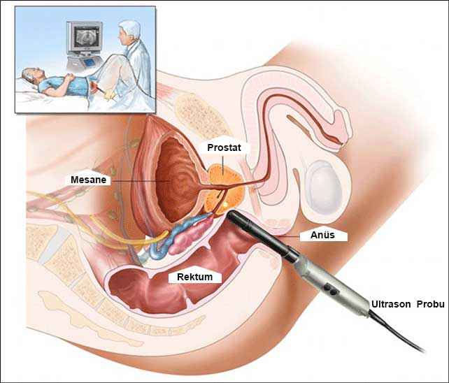 prostat-nedir-ve-tedavi-yontemleri-nelerdir-6