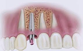 sahte-implant-nasil-anlasilir-1