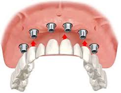 sahte-implant-nasil-anlasilir-3