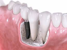 sahte-implant-nasil-anlasilir